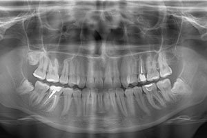 Панорамный снимок зубов.jpg?v=0